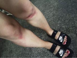 膝盖破皮图片,膝盖破皮急救与护理攻略